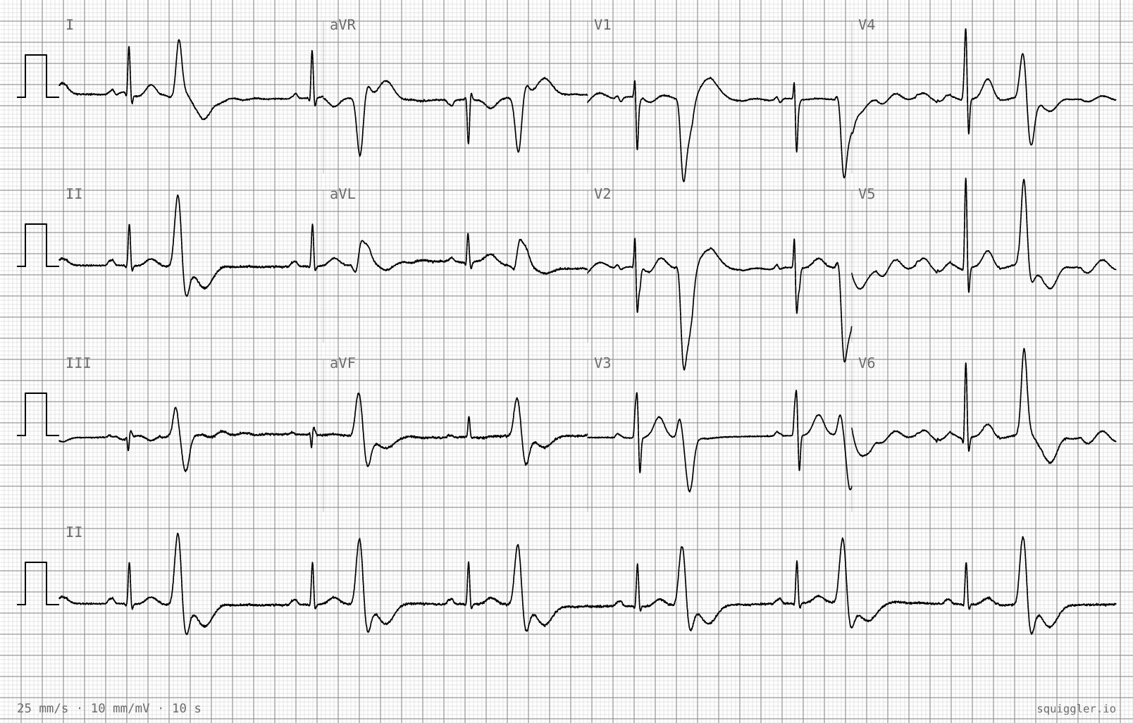The tracing for the quiz “A thumping in the chest when he lies down at night, going on for months”.