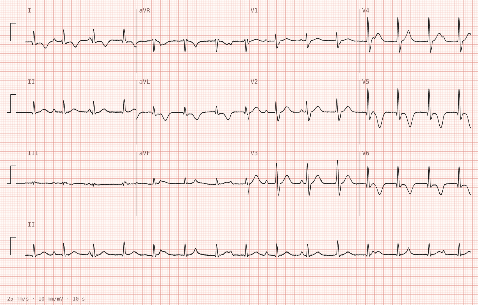 Tracing 1 of 2 for the quiz “Abnormal monitor tracing noted on the post-operative ward round”.