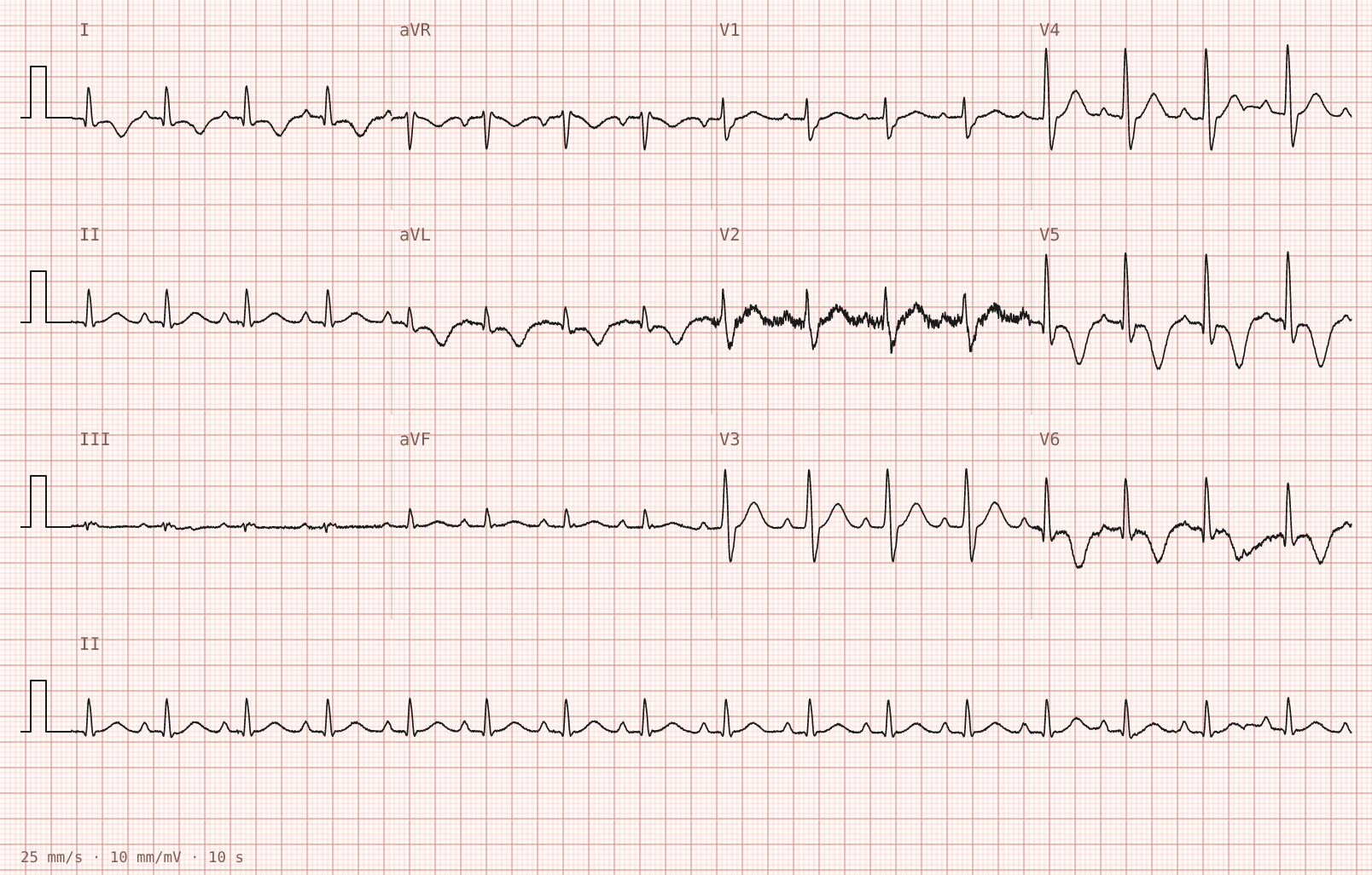 Tracing 2 of 2 for the quiz “Abnormal monitor tracing noted on the post-operative ward round”.