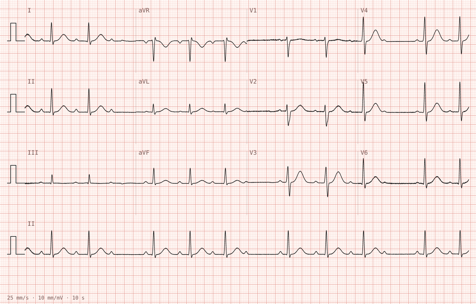 Tracing 1 of 2 for the quiz “An irregular pulse at a pre-employment medical”.
