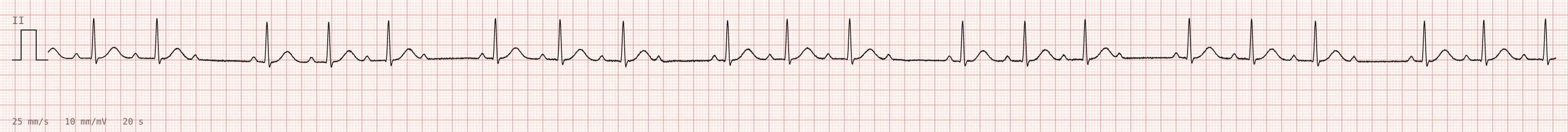 Tracing 2 of 2 for the quiz “An irregular pulse at a pre-employment medical”.