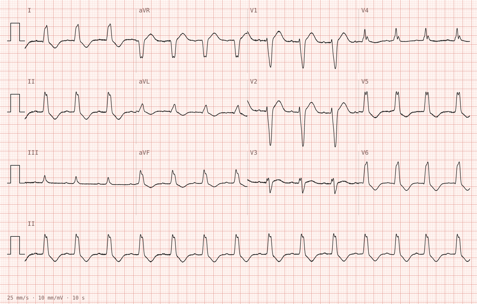 The tracing for the quiz “Breathlessness during a viral chest infection”.