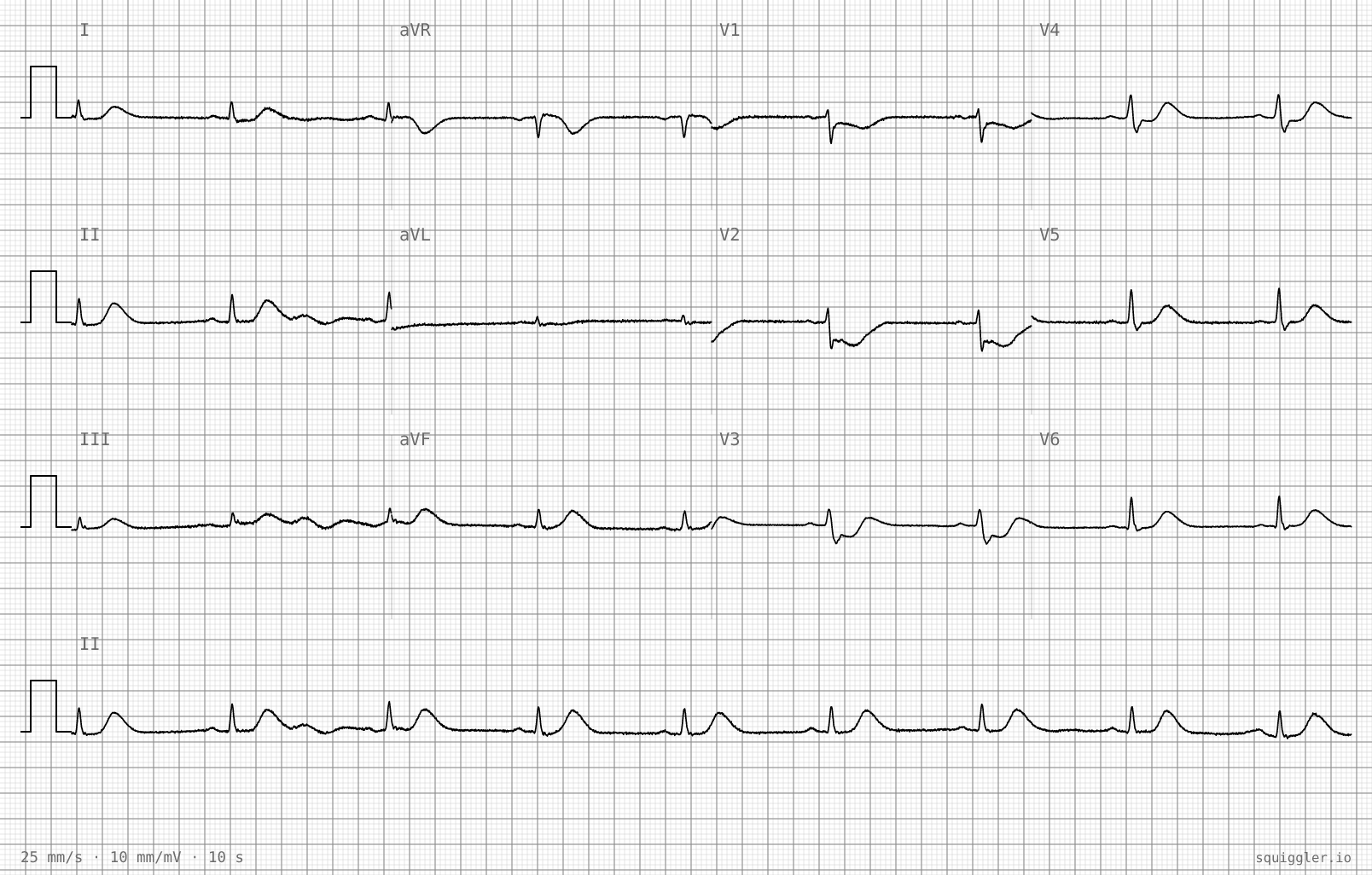 The tracing for the quiz “Central chest heaviness with nausea for ninety minutes”.