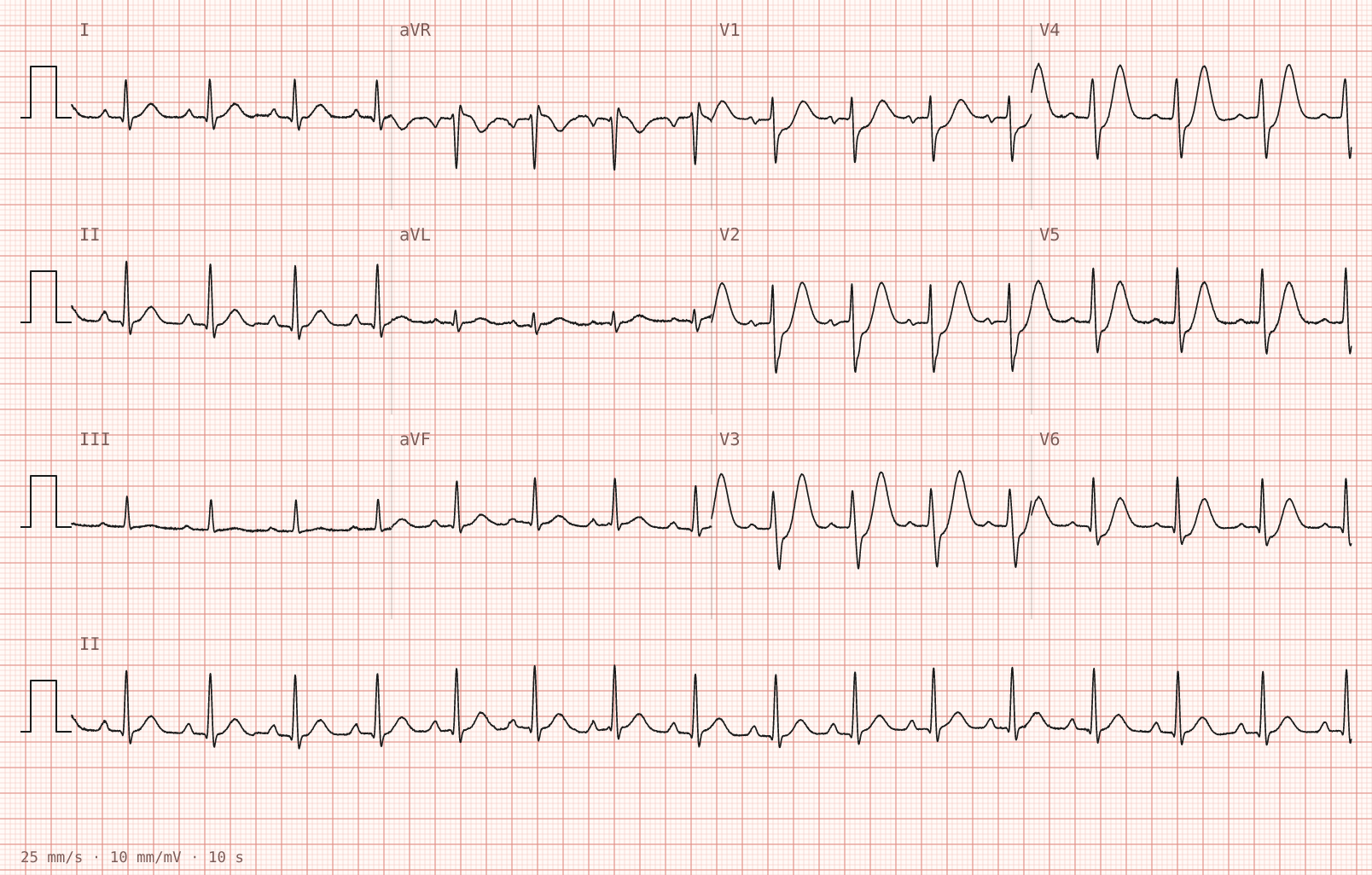 Tracing 1 of 2 for the quiz “Central chest pain for forty minutes, still present”.