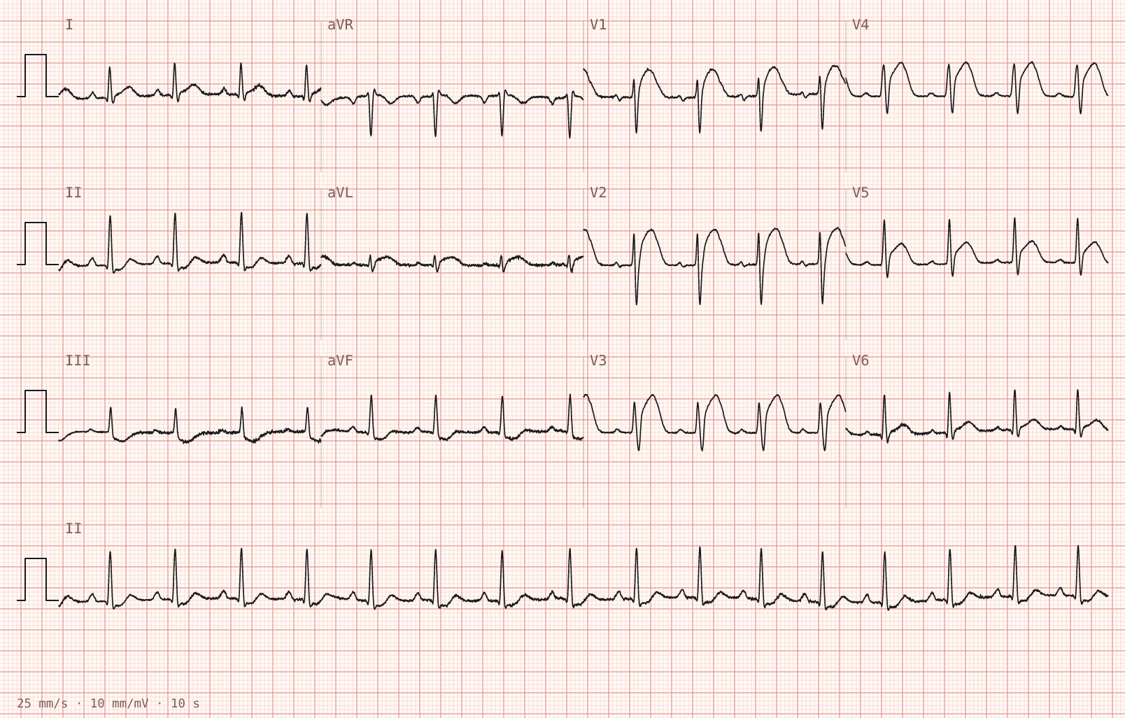 Tracing 2 of 2 for the quiz “Central chest pain for forty minutes, still present”.