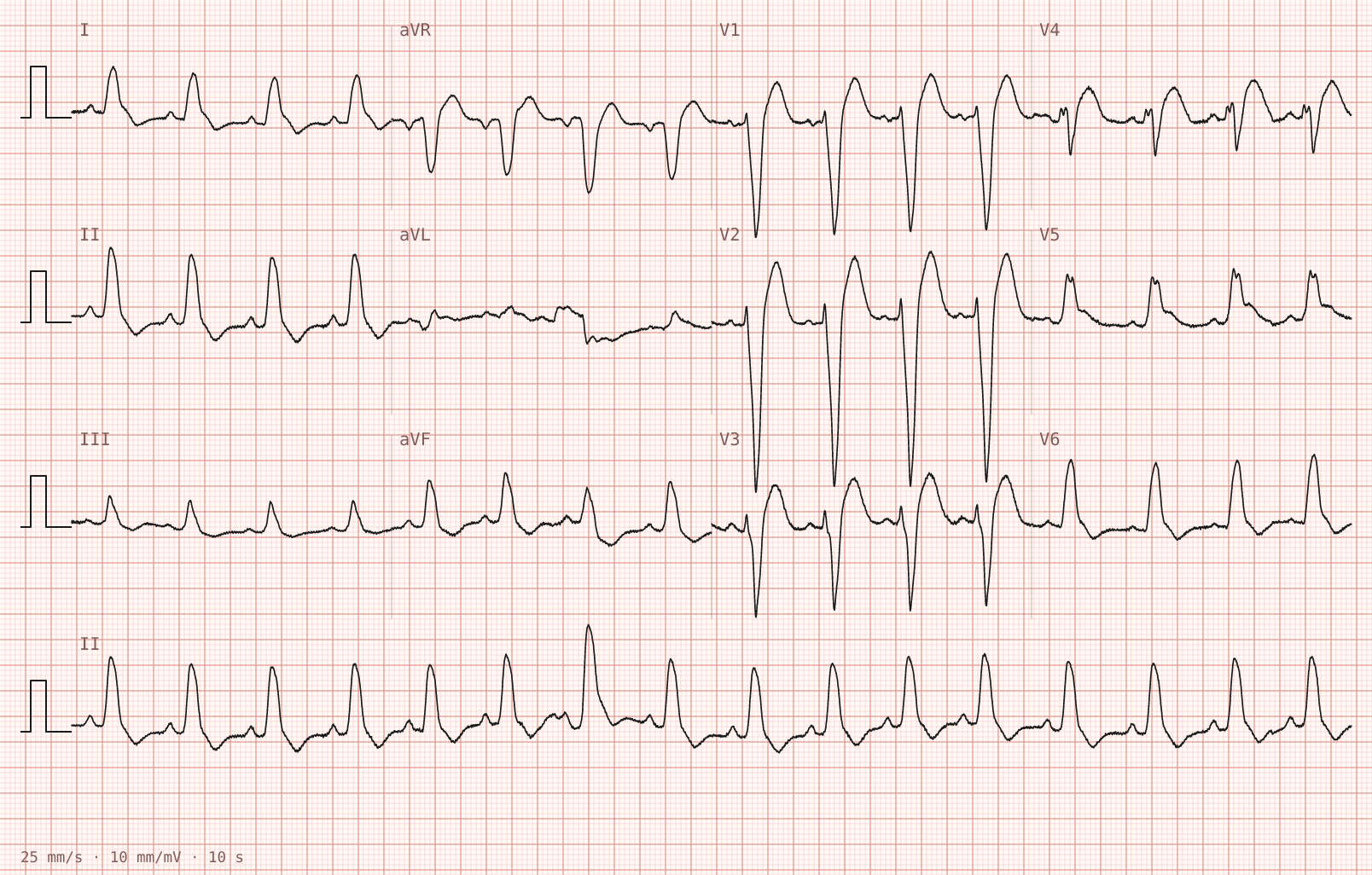 Tracing 1 of 2 for the quiz “Central chest pain for two hours, still present”.