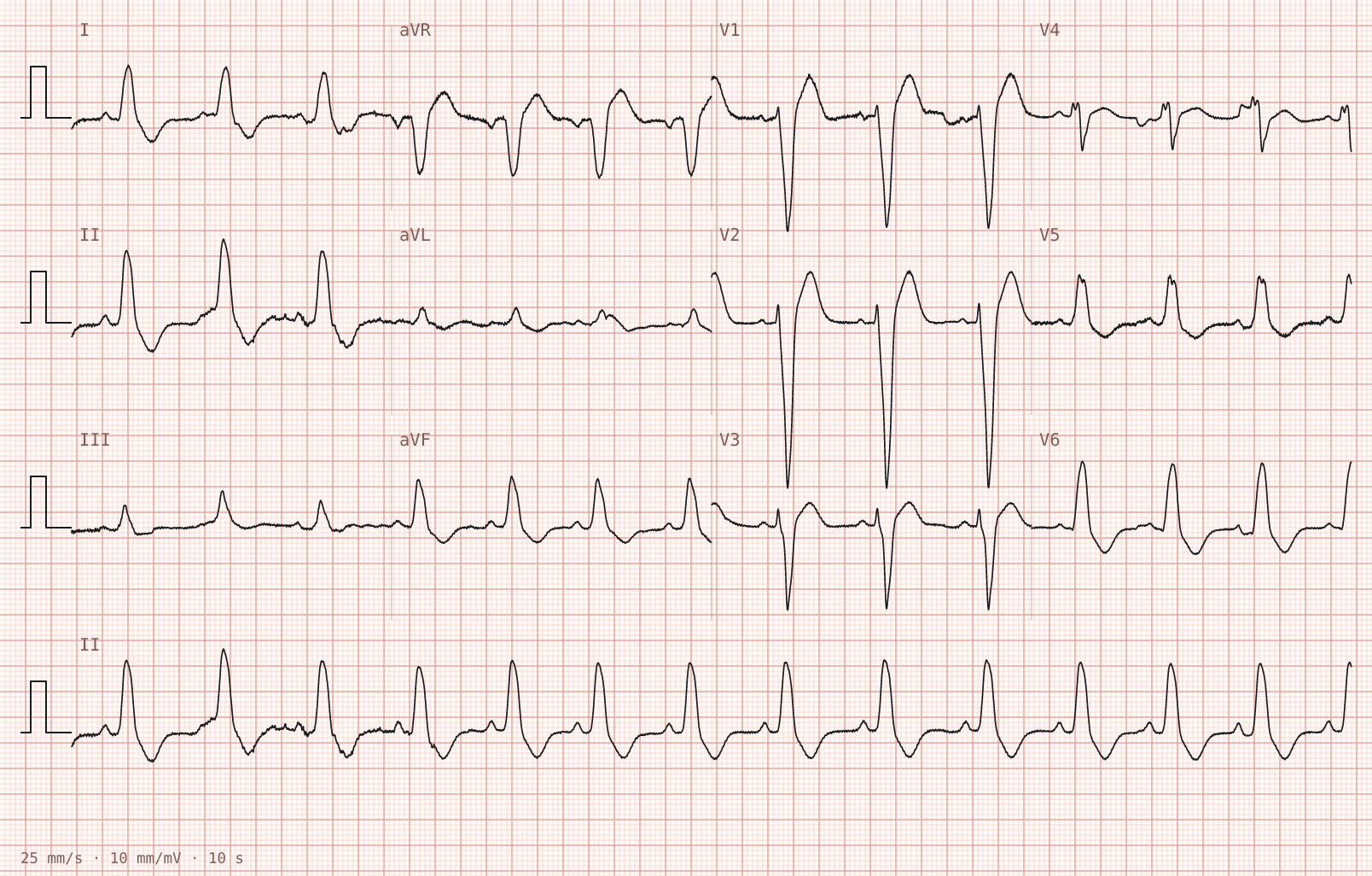 Tracing 2 of 2 for the quiz “Central chest pain for two hours, still present”.