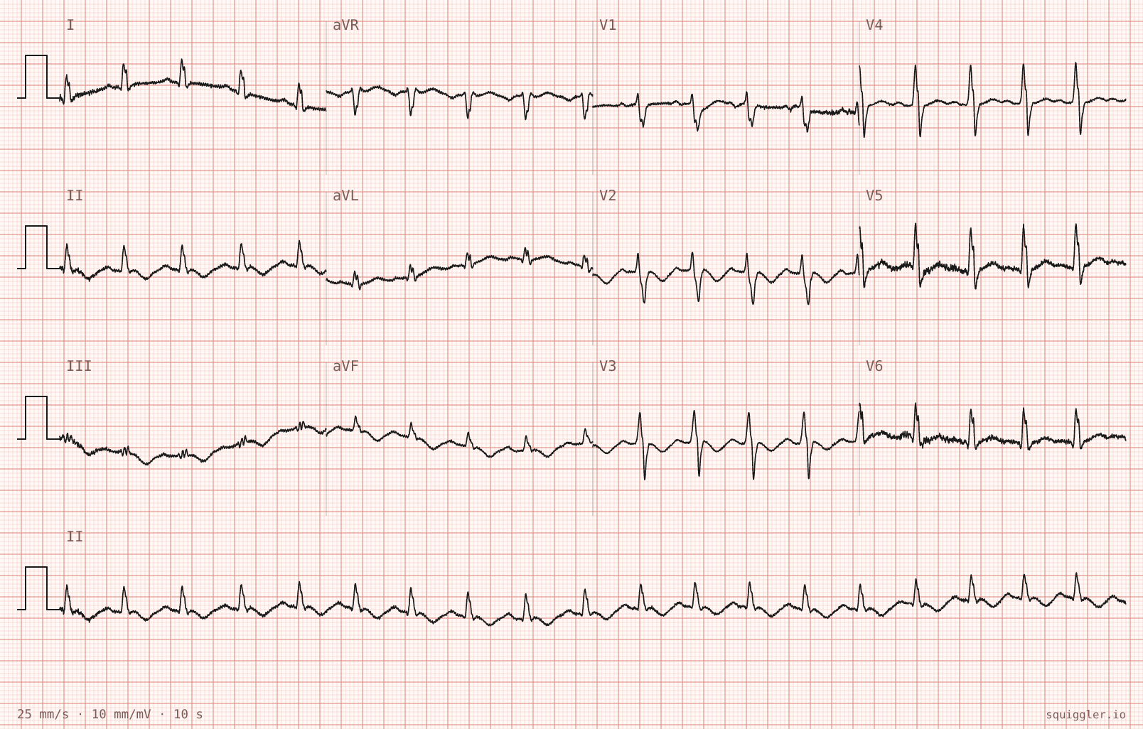 The tracing for the quiz “Central chest tightness and breathlessness for two hours”.