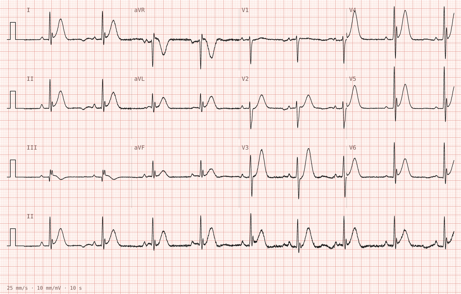 Tracing 1 of 2 for the quiz “Central chest tightness during a five-a-side football match, settled after twenty minutes”.