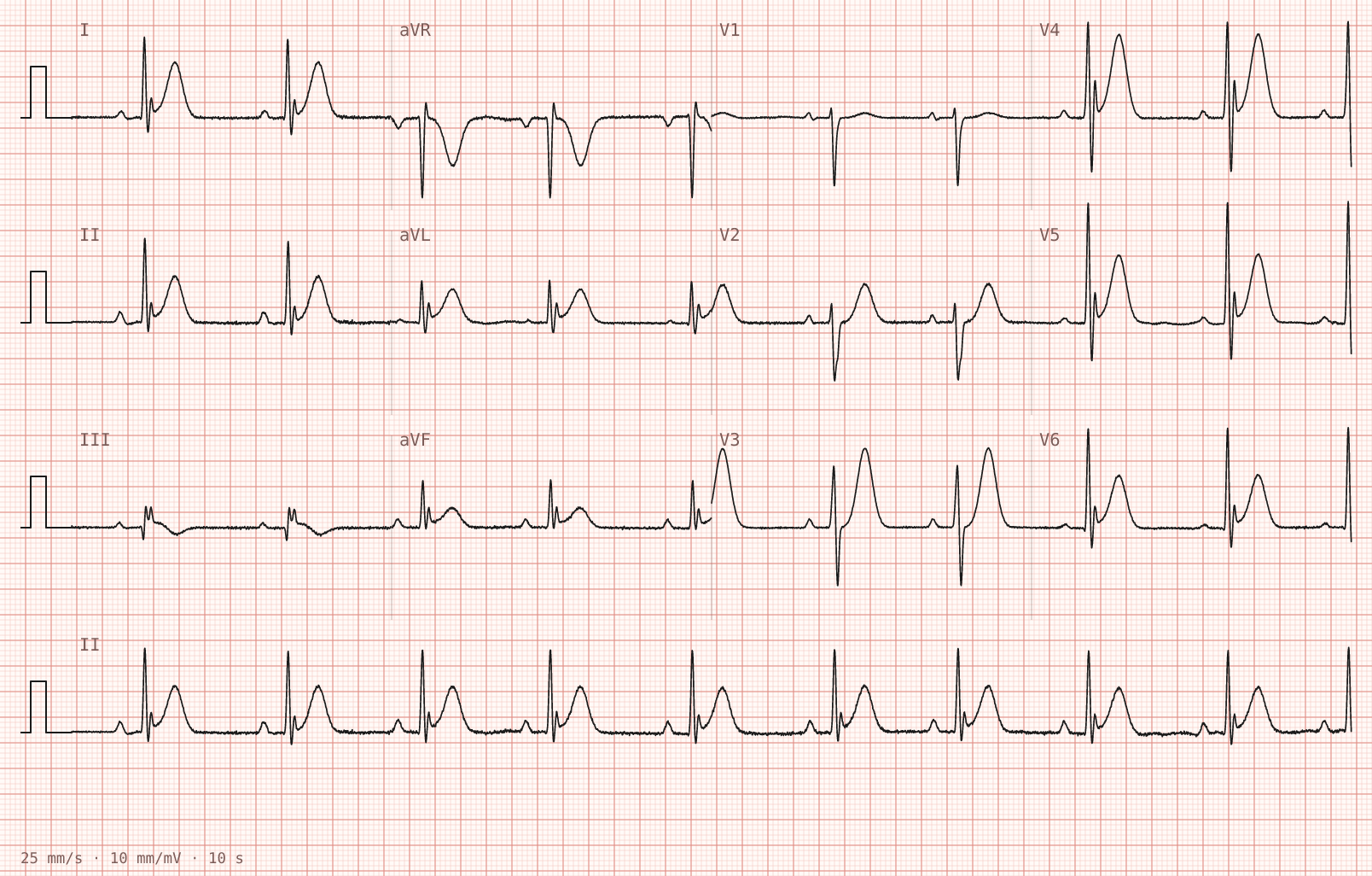 Tracing 2 of 2 for the quiz “Central chest tightness during a five-a-side football match, settled after twenty minutes”.