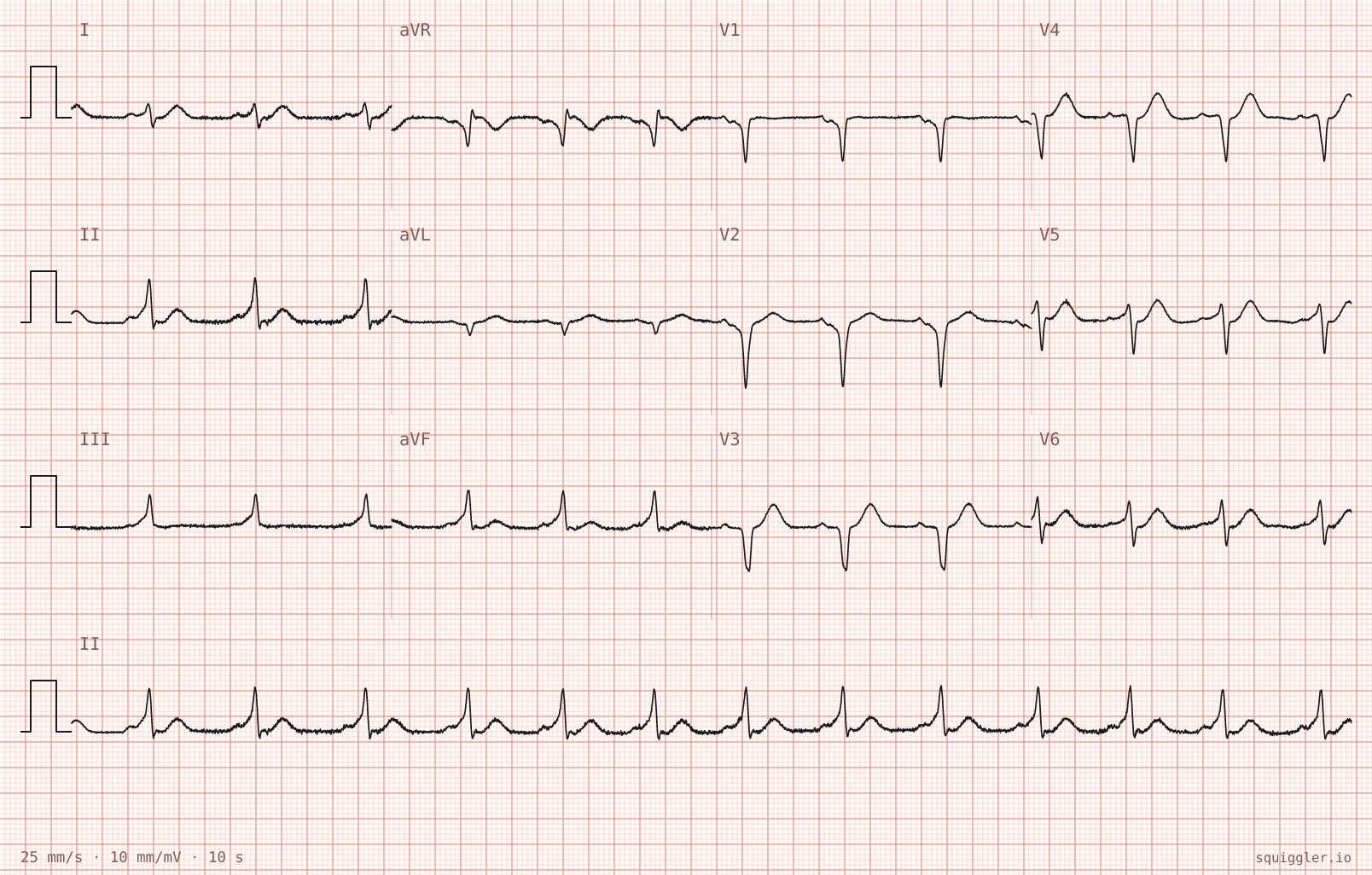 Tracing 1 of 2 for the quiz “Club doctor said my heart tracing looked odd”.