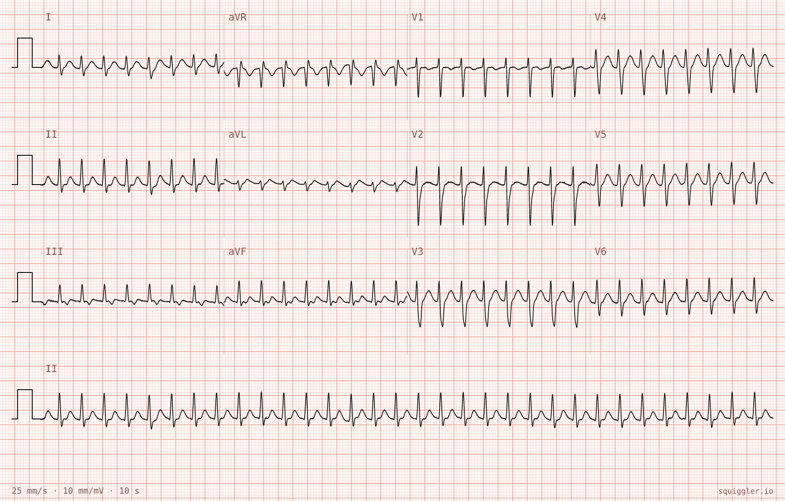 Tracing 2 of 2 for the quiz “Club doctor said my heart tracing looked odd”.