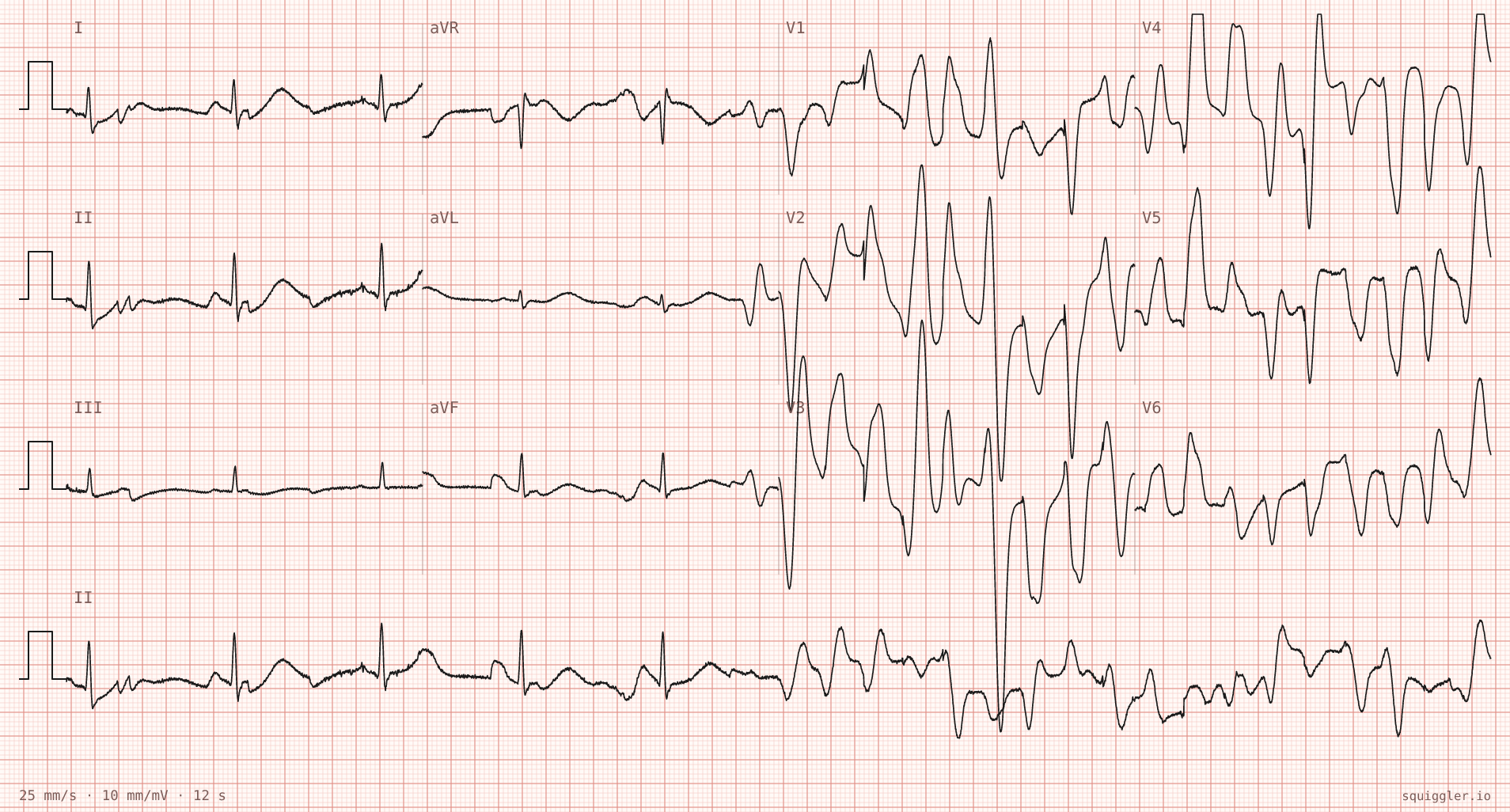 The tracing for the quiz “Collapse on the cardiology ward”.
