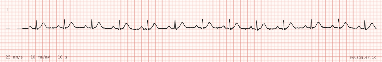Tracing 2 of 2 for the quiz “Dizziness and two near-faints since this morning”.