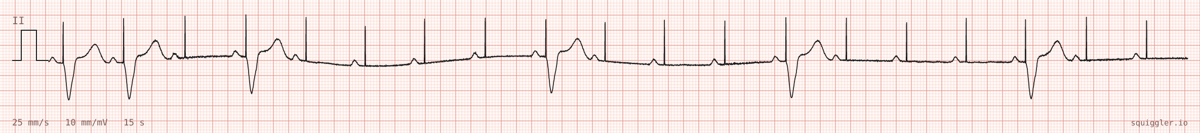 Tracing 1 of 2 for the quiz “Hiccups since the new pacemaker went in”.
