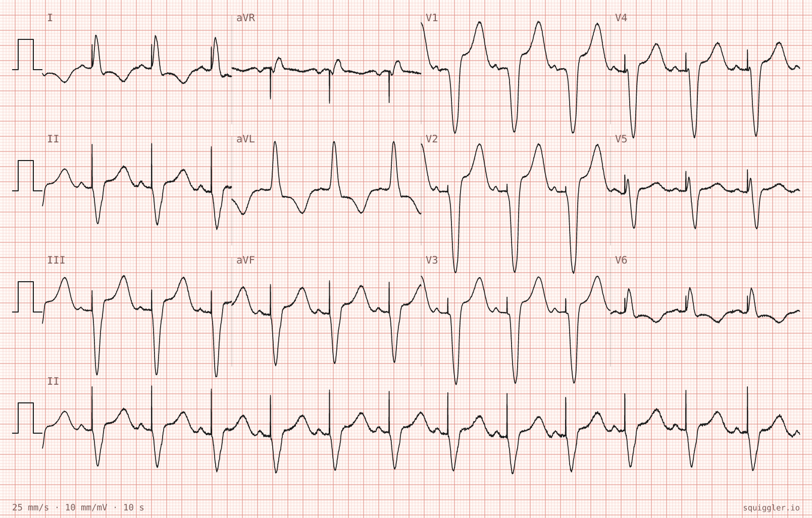 Tracing 2 of 2 for the quiz “Hiccups since the new pacemaker went in”.