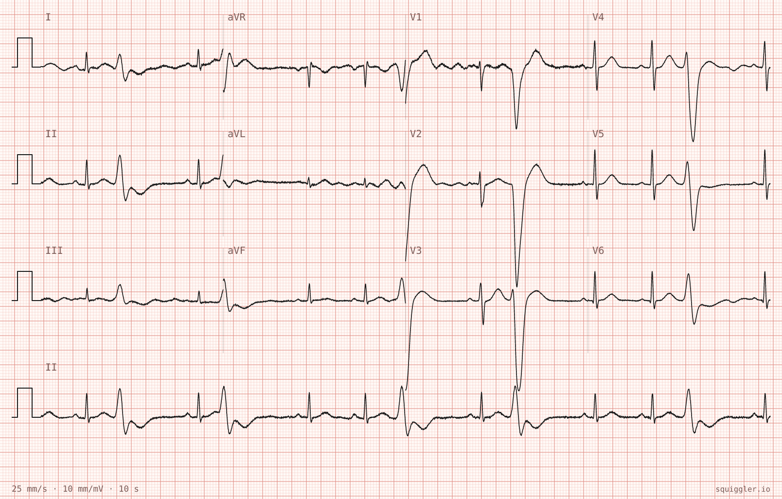 The tracing for the quiz “Intermittent palpitations noticed during a night shift”.