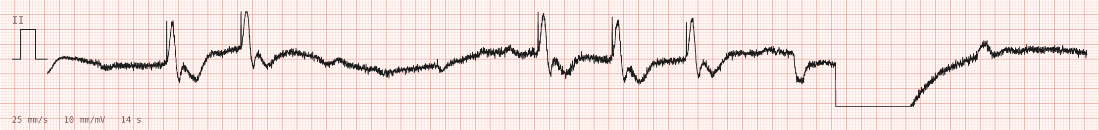 Tracing 1 of 2 for the quiz “Monitor alarm during a laparoscopic operation”.
