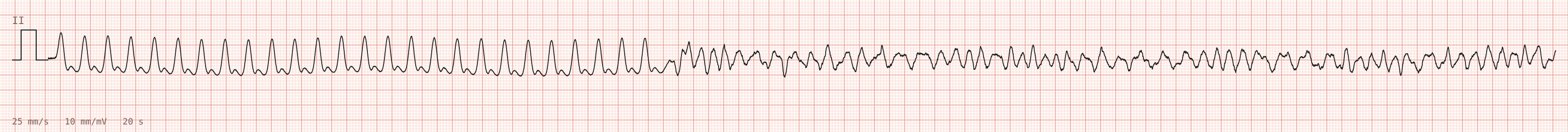 The tracing for the quiz “Monitor alarm on the coronary care unit”.