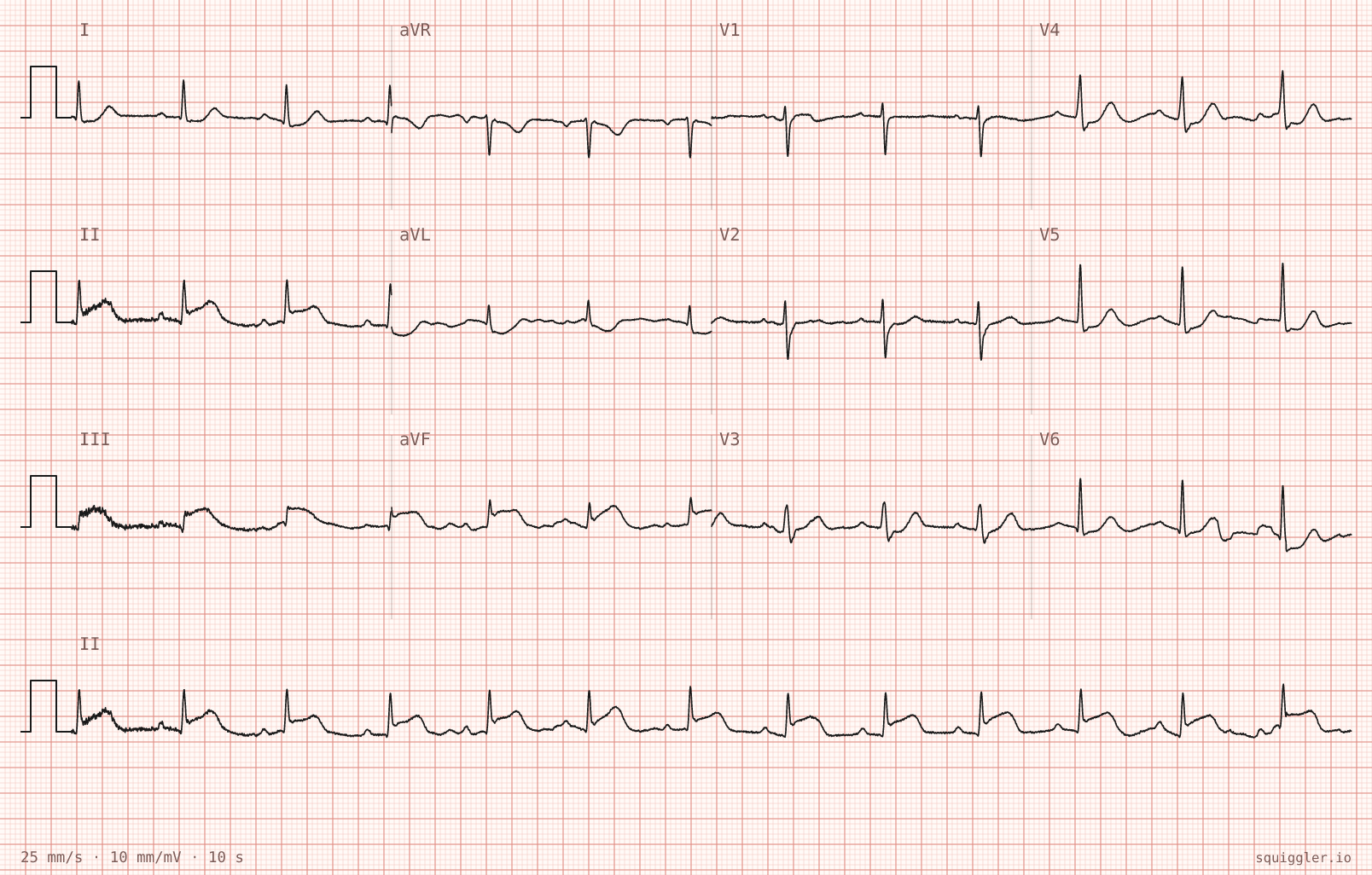 ECG: NAP's inferior STEMI preset, opened in Squiggler