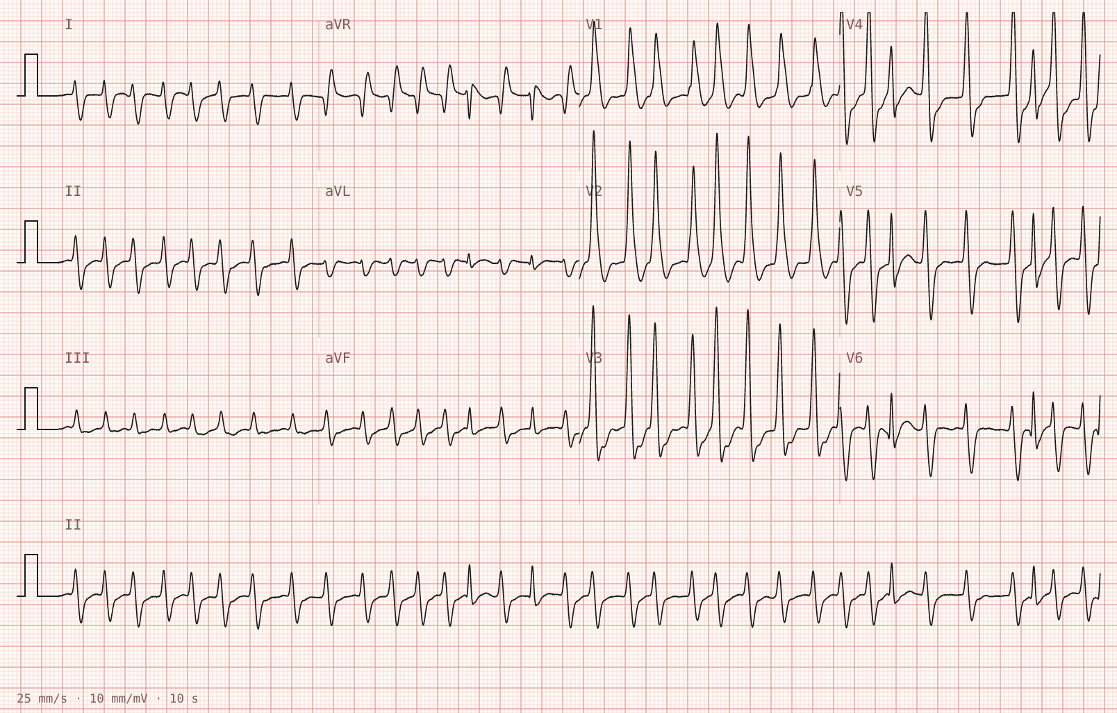 Tracing 1 of 2 for the quiz “Palpitations and breathlessness that began during a football match an hour ago”.