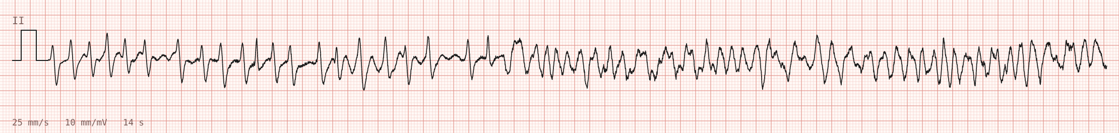 Tracing 2 of 2 for the quiz “Palpitations and breathlessness that began during a football match an hour ago”.