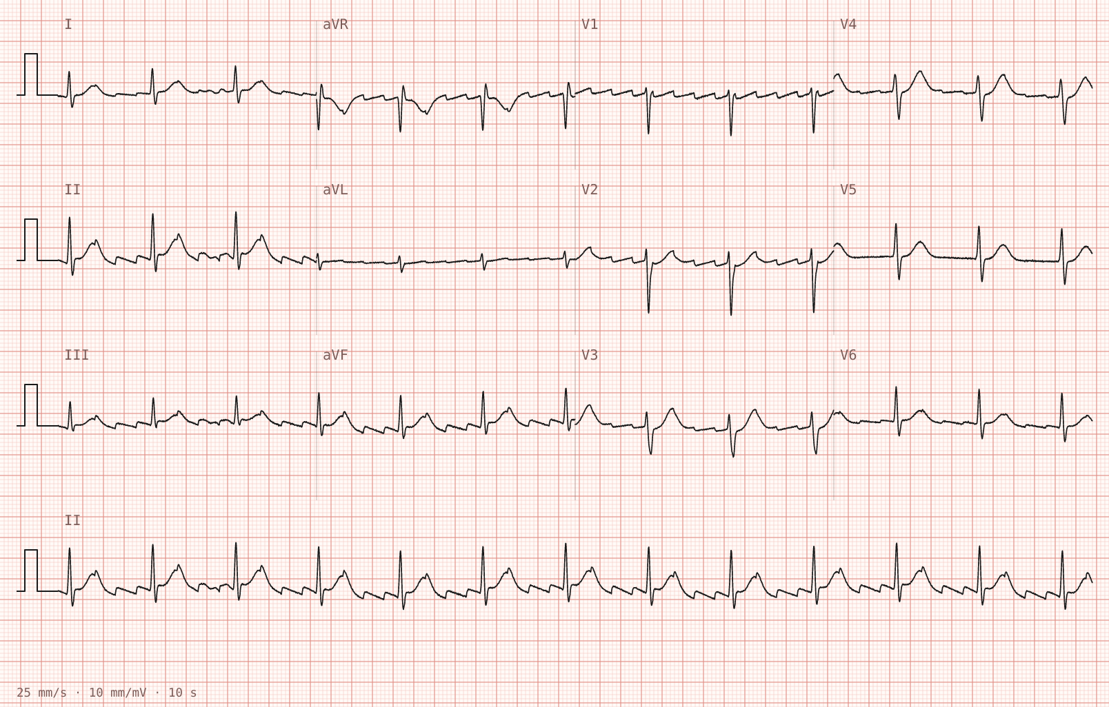 Tracing 2 of 2 for the quiz “Palpitations for three weeks, worse over the last two days”.