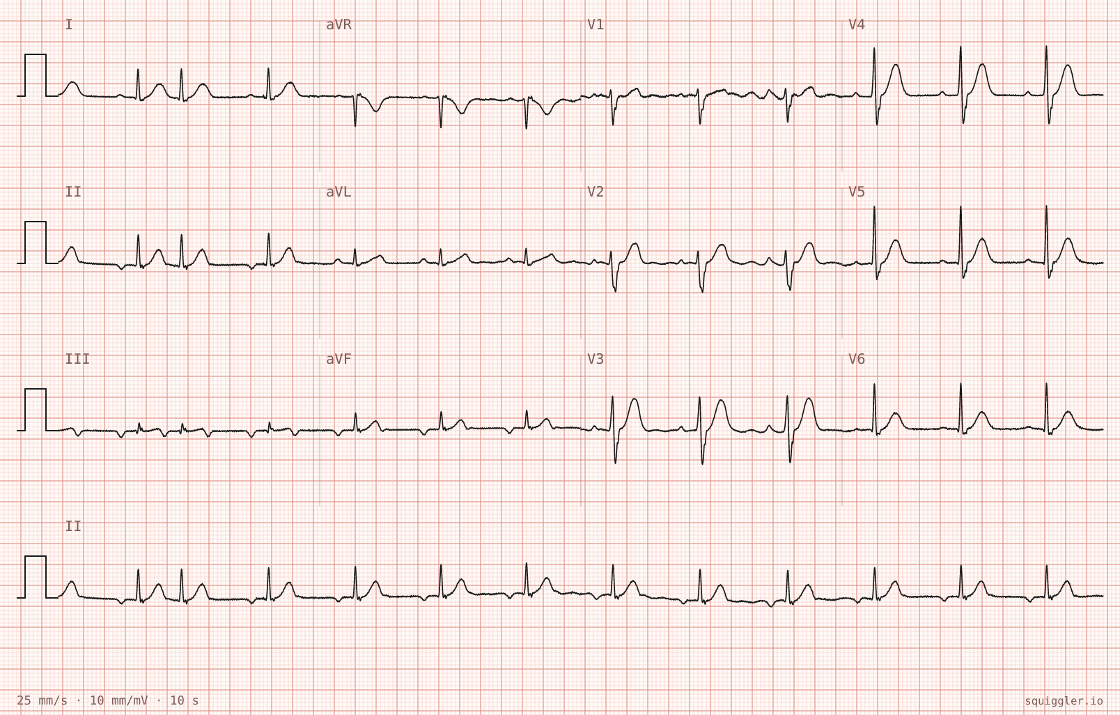 The tracing for the quiz “Palpitations on and off for three weeks, now persistent for two hours with mild breathlessness”.