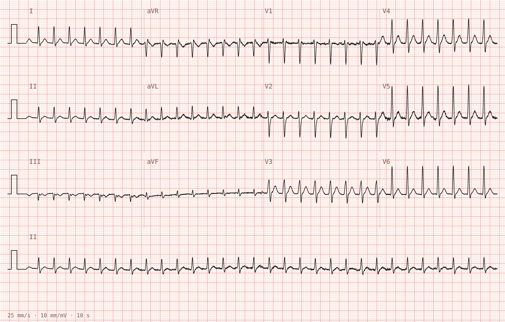 Tracing 1 of 2 for the quiz “Palpitations that started suddenly during a lesson”.