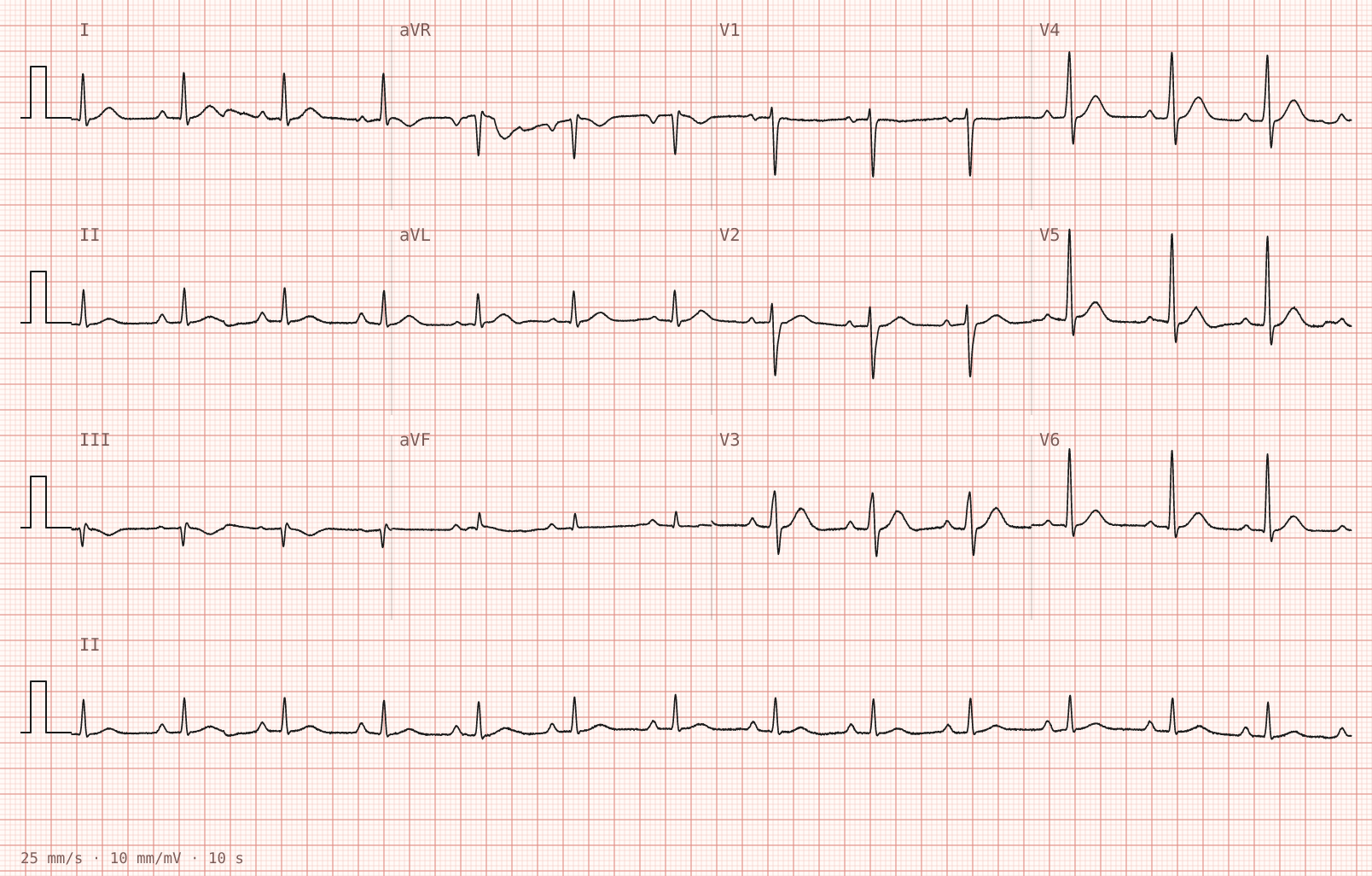 Tracing 2 of 2 for the quiz “Palpitations that started suddenly during a lesson”.