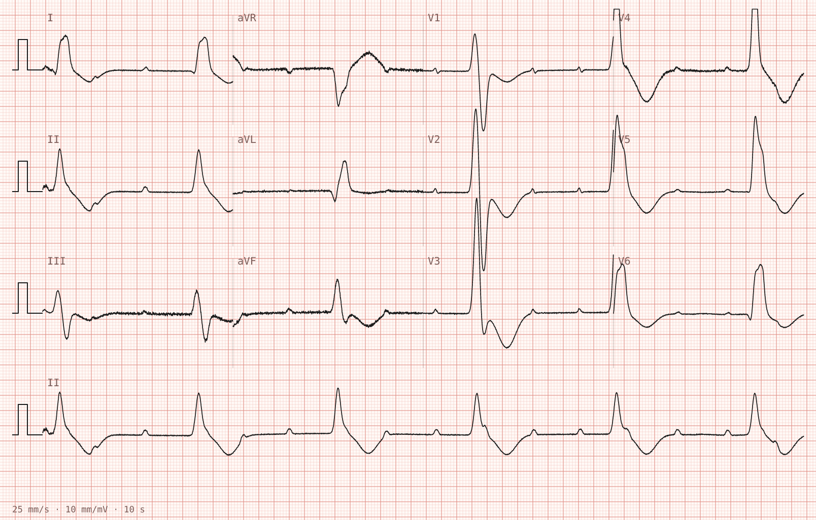 The tracing for the quiz “Presyncope, and a pulse of about thirty”.