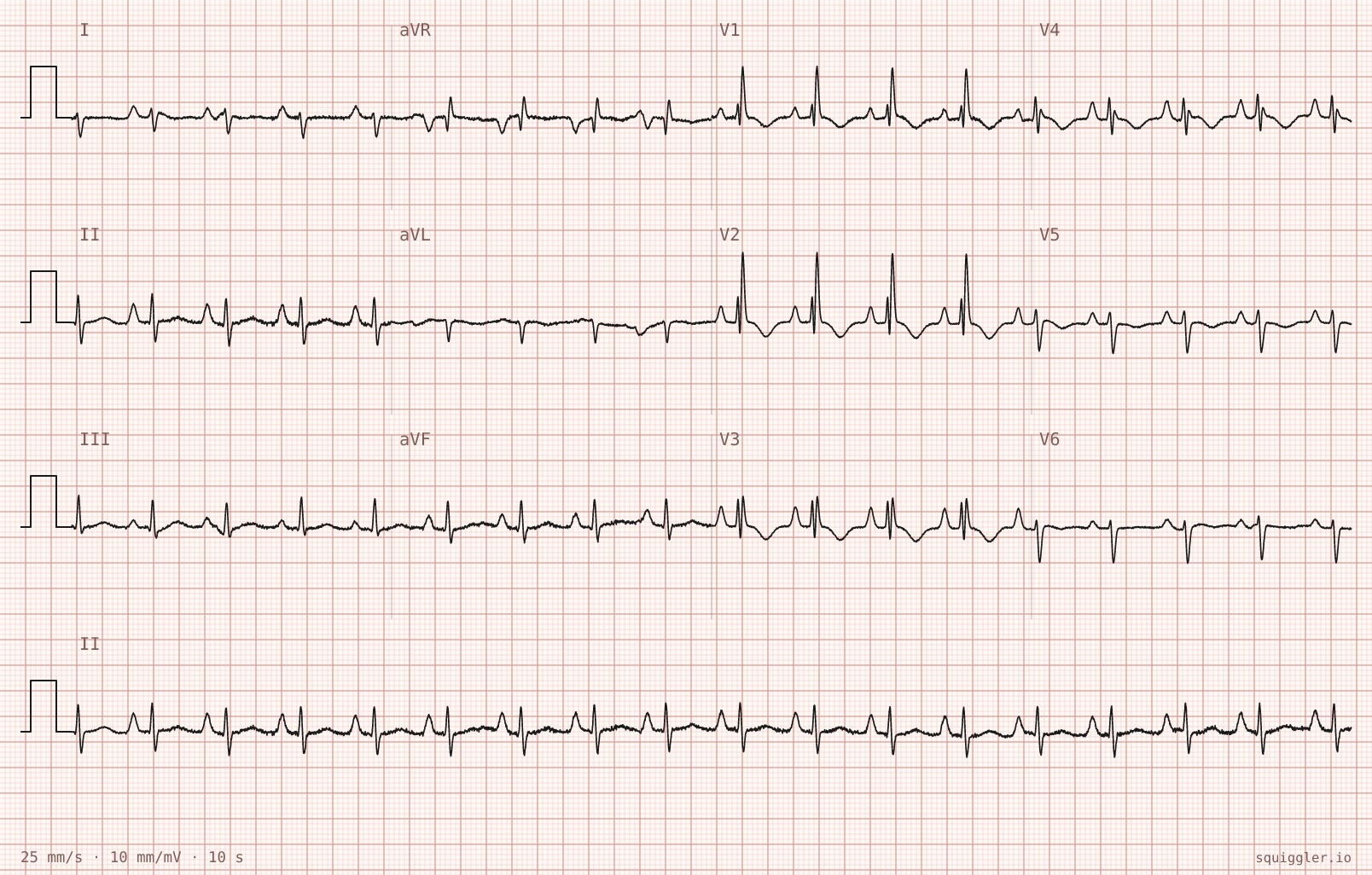 The tracing for the quiz “Progressive exertional breathlessness and one episode of near-syncope”.