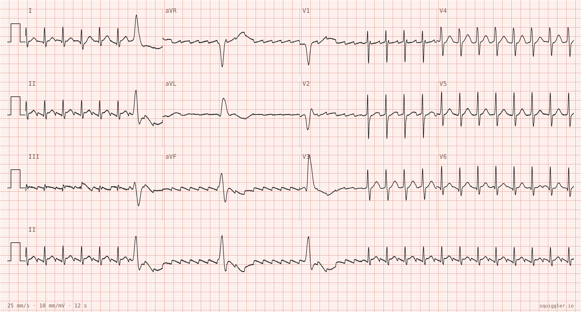 The tracing for the quiz “Rapid regular palpitations for two hours”.