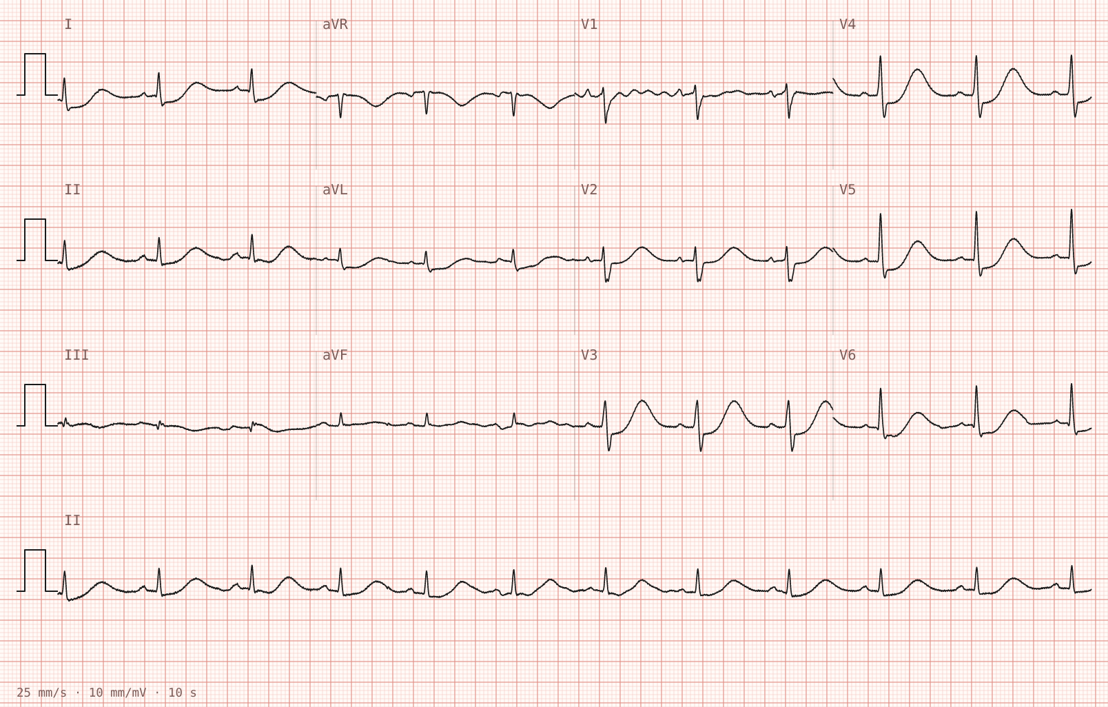 The tracing for the quiz “Recurrent chest pressure at rest since early morning”.