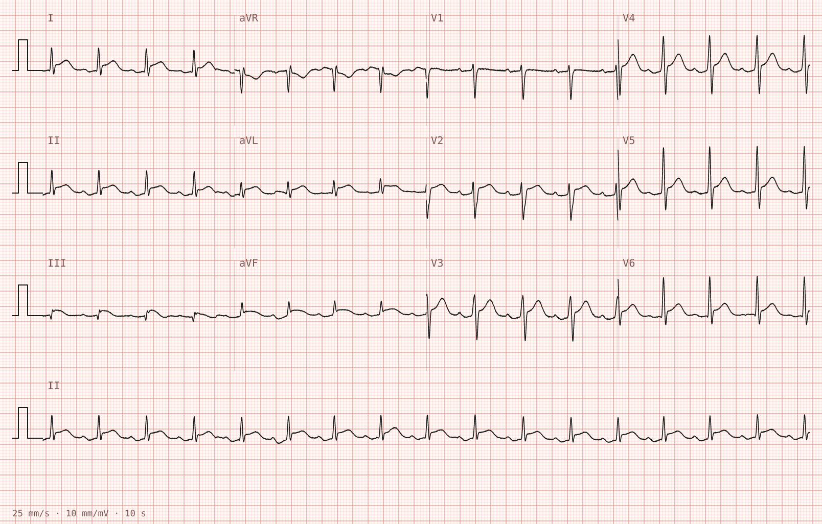 Tracing 1 of 2 for the quiz “Sharp central chest pain for a day, worse lying flat”.