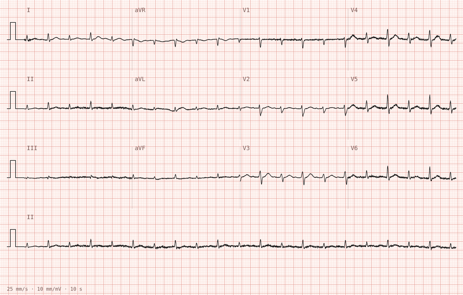 Tracing 2 of 2 for the quiz “Sharp central chest pain for a day, worse lying flat”.