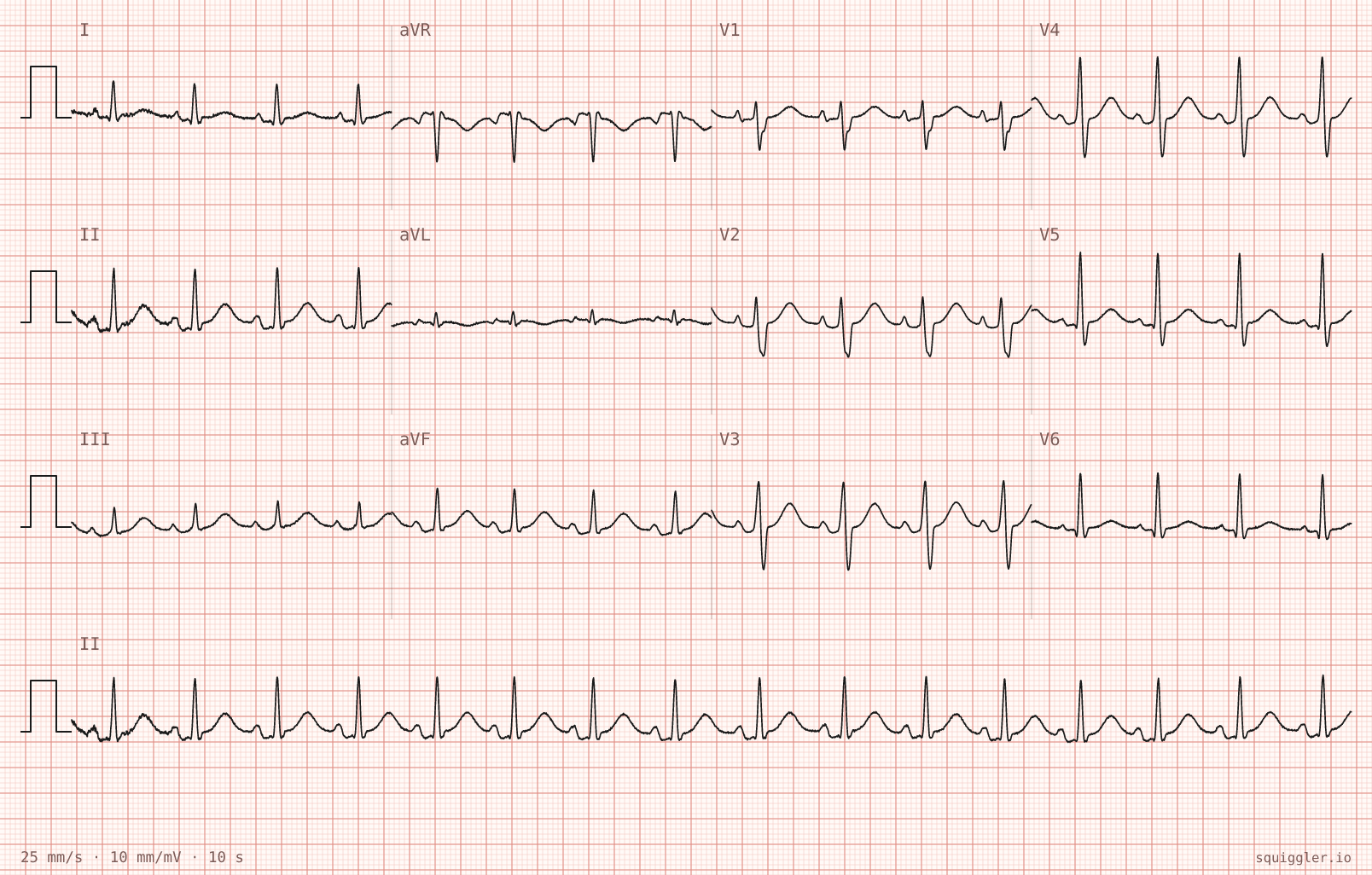 Tracing 1 of 2 for the quiz “Sharp central chest pain for two days, worse lying flat”.