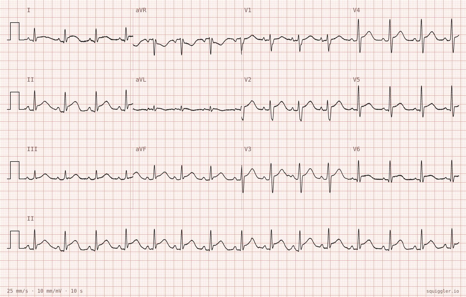 Tracing 2 of 2 for the quiz “Sharp central chest pain for two days, worse lying flat”.