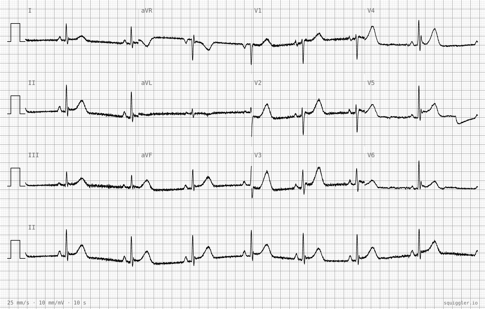 Tracing 2 of 2 for the quiz “Sharp pain under my left ribs since moving a sofa”.