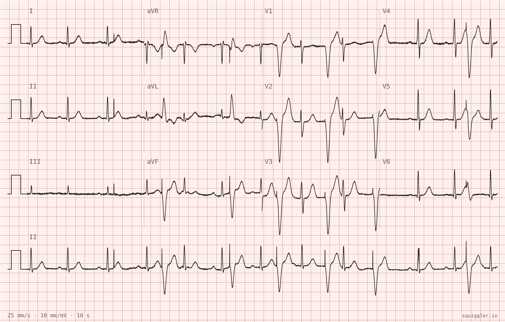 ECG: 12-lead, 25 mm/s