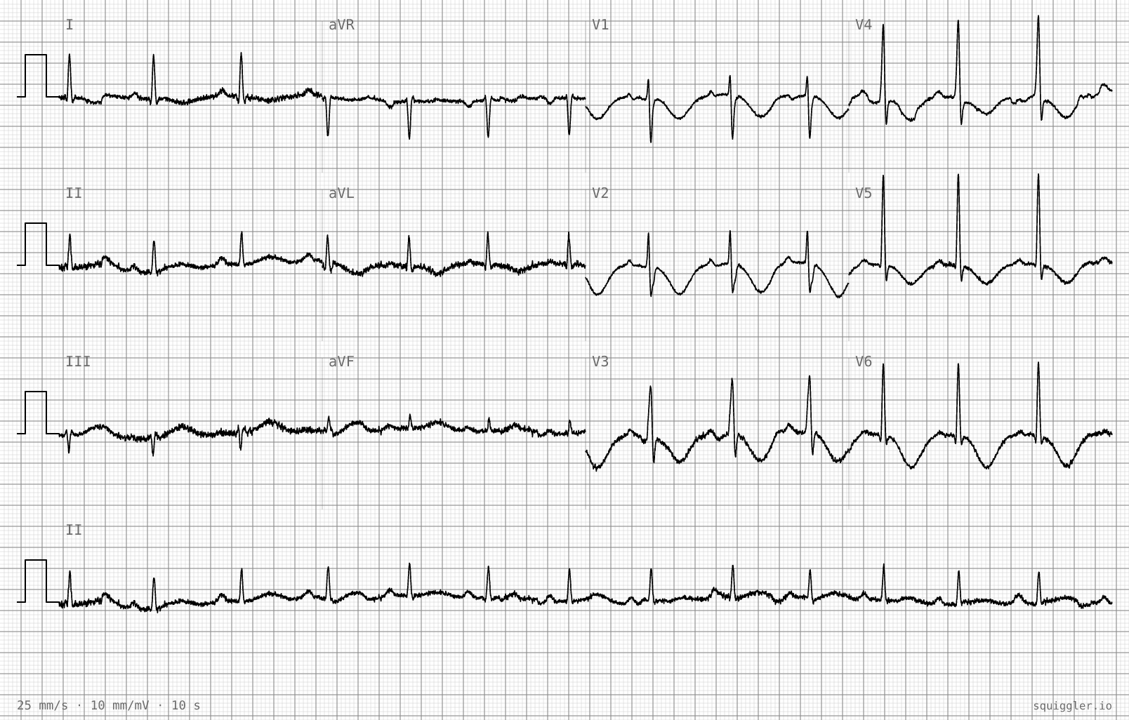 The tracing for the quiz “Sudden headache at the gym, now drowsy”.