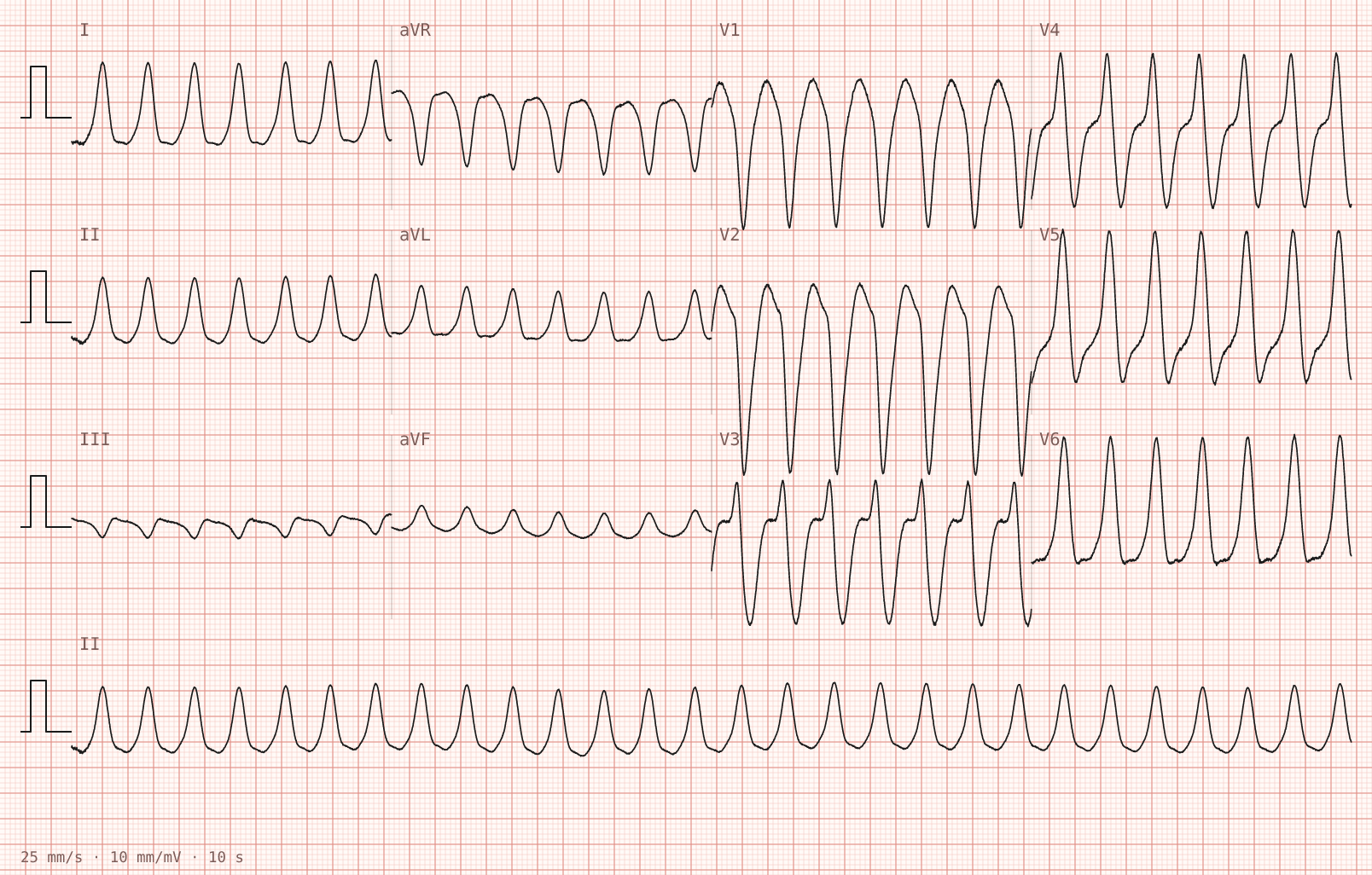 Tracing 1 of 2 for the quiz “Sudden palpitations and light-headedness on the assessment unit”.
