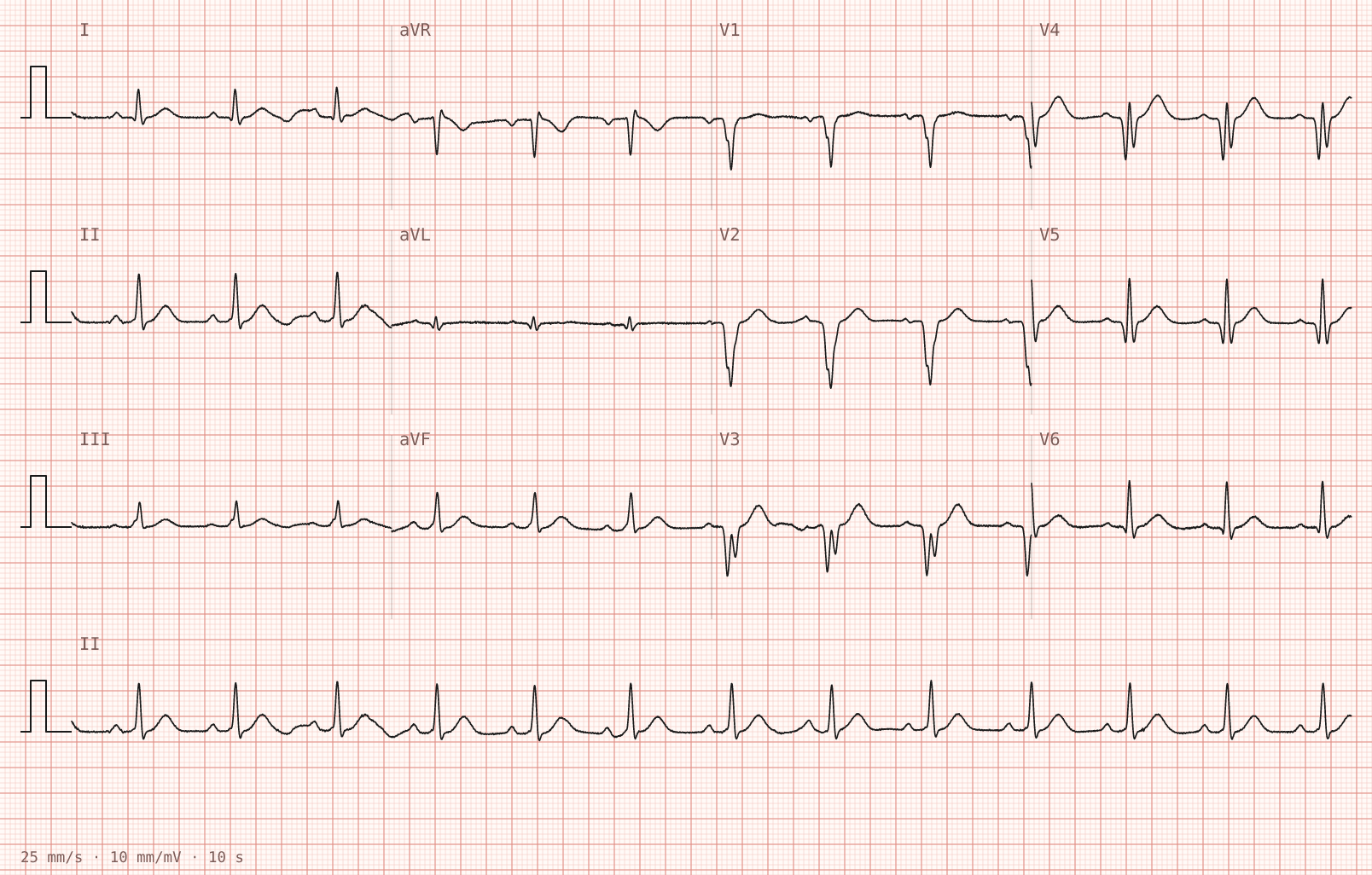 Tracing 2 of 2 for the quiz “Sudden palpitations and light-headedness on the assessment unit”.