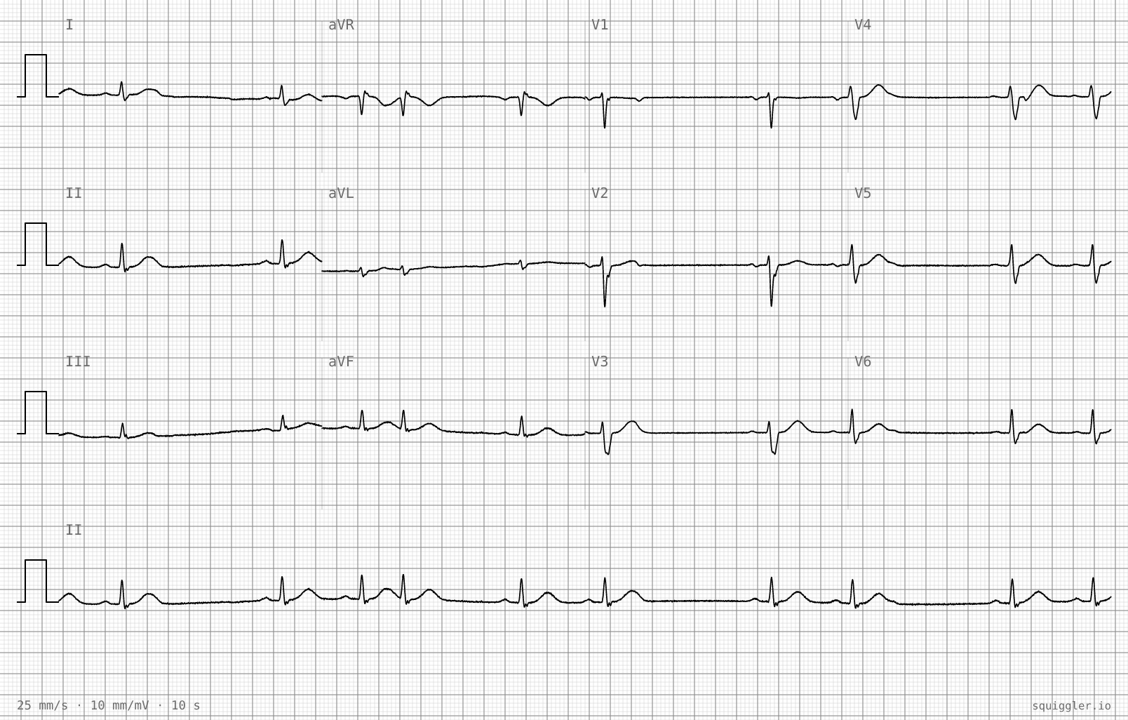 Tracing 1 of 2 for the quiz “Three months of palpitations”.