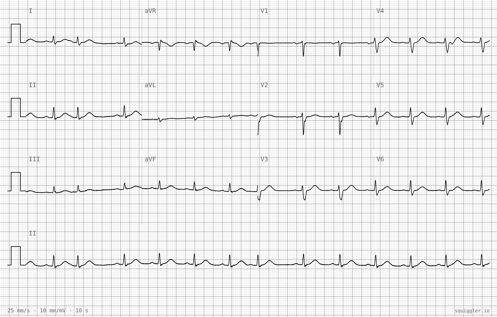 Tracing 2 of 2 for the quiz “Three months of palpitations”.