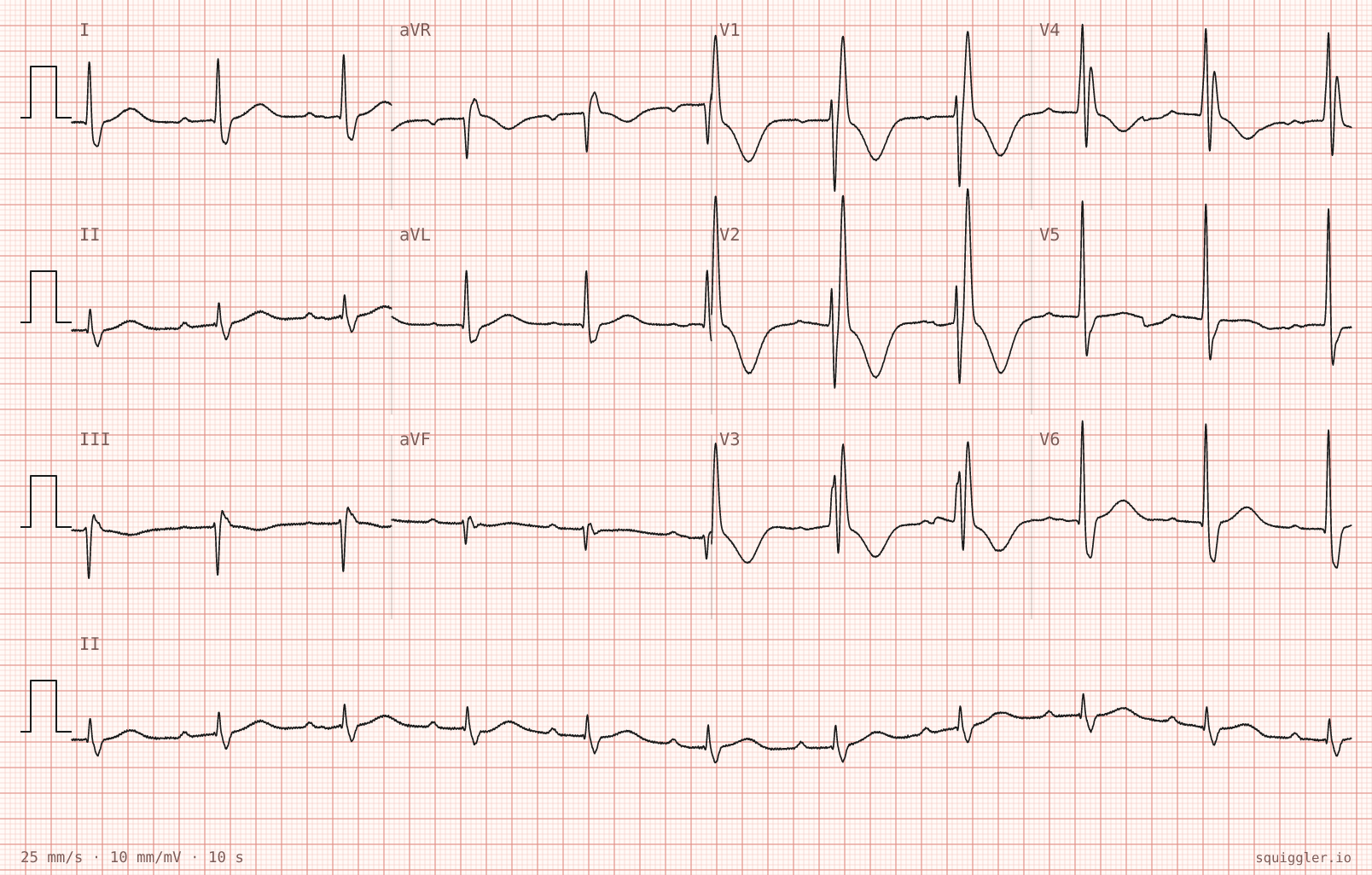 The tracing for the quiz “Two episodes of sudden loss of consciousness”.