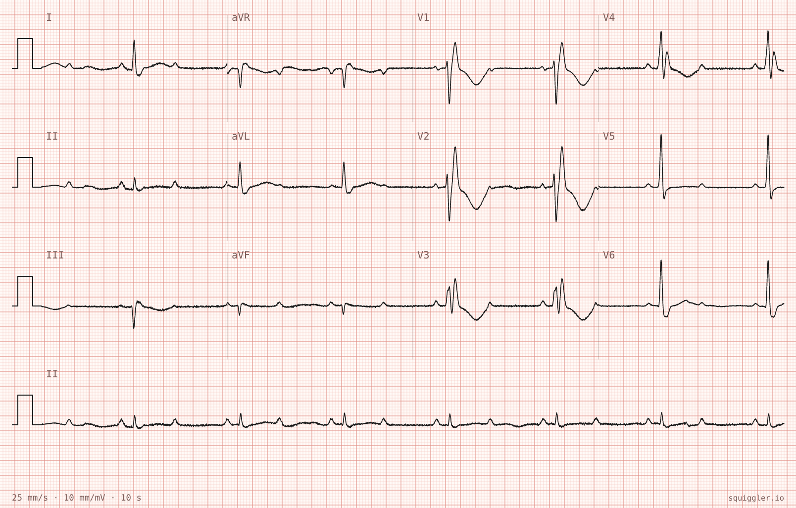 Tracing 1 of 2 for the quiz “Two falls this week, no memory of hitting the ground”.