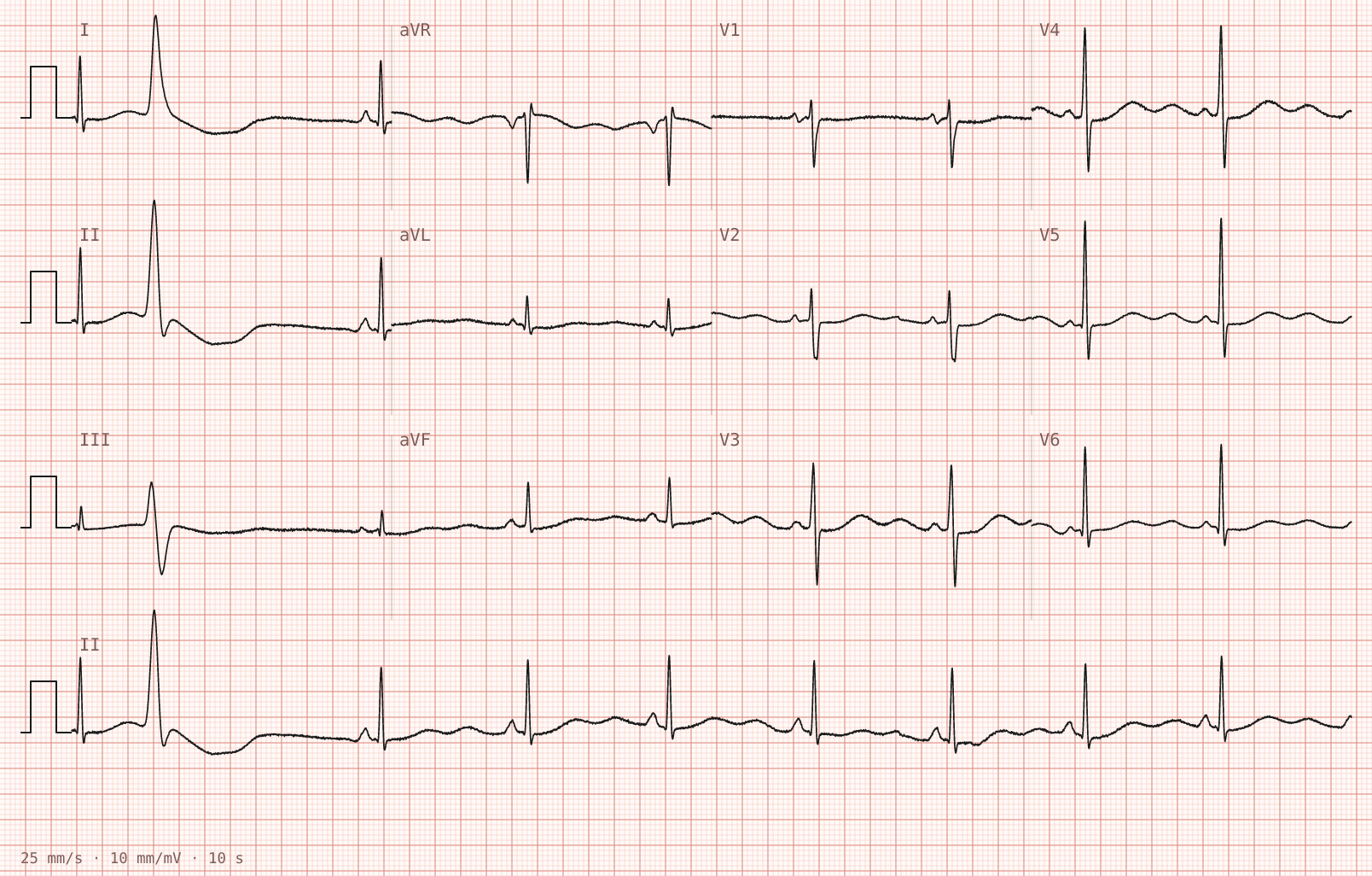Tracing 1 of 2 for the quiz “Weakness and palpitations after rapid weight loss for a boxing weigh-in”.