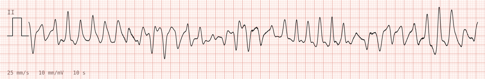 Tracing 2 of 2 for the quiz “Weakness and palpitations after rapid weight loss for a boxing weigh-in”.