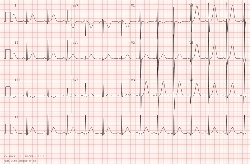 Fourteen-year-old — synthetic ECG on millimetre paper